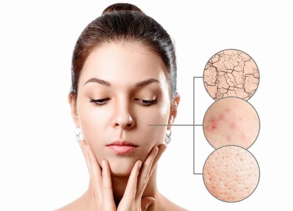 Gia công Xịt khoáng kiềm dầu 3 cải thiện da của chiết xuất cây phỉ