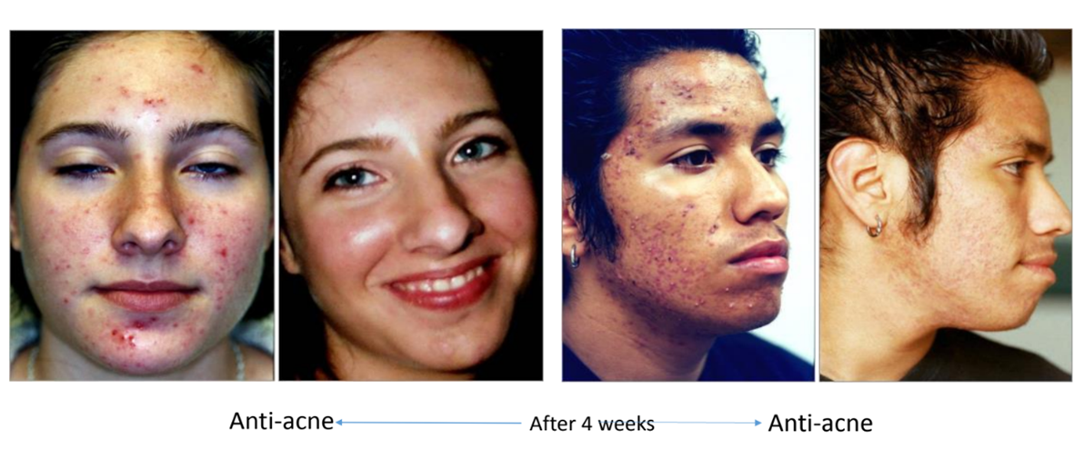 trước sau dùng kem vi kim tảo biển được gia công bởi IFREE