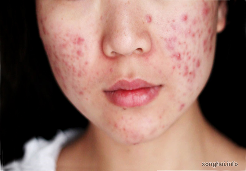 nguyen nhan khien da bi mun