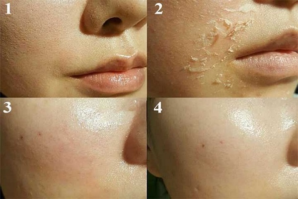 Triệu chứng sau vi kim khác lạ nhắc bạn nên tới Spa kiểm tra thật sớm 9 triệu chứng sau vi kim