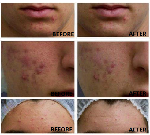 Gia công Serum trị mụn Tràm Trà 3 giảm mụn giảm thâm sau 7 ngày khi dùng serum trị mụn tràm trà được gia công bởi IFREEE, hình ảnh được cung cấp từ người kinh doanh mỹ phẩm và khách hàng của họ gửi tới IFREE