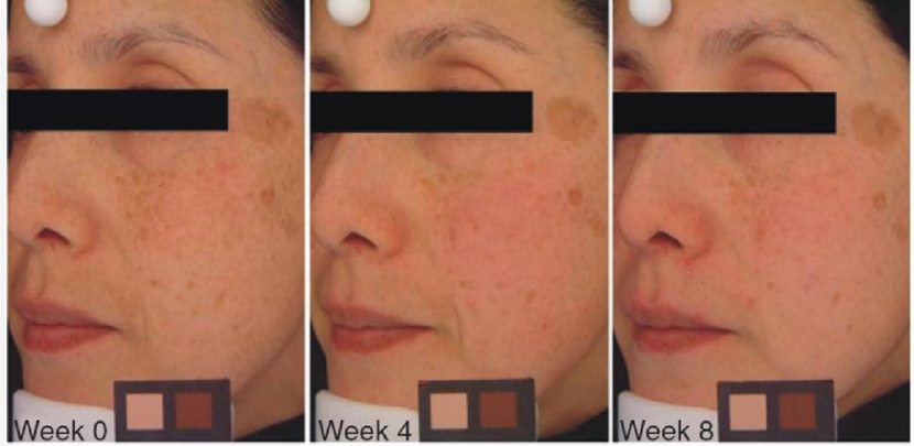 hiểu quả trị nám,đốm nâu sỉn màu vitamin b3, vitamin b3 là hoạt chất quan trọng trong công thức gia công mỹ phẩm