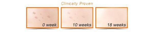 Gia công Kem trị nám tranexamic acid 10% 7 tác dụng trị nám tranexamic acid