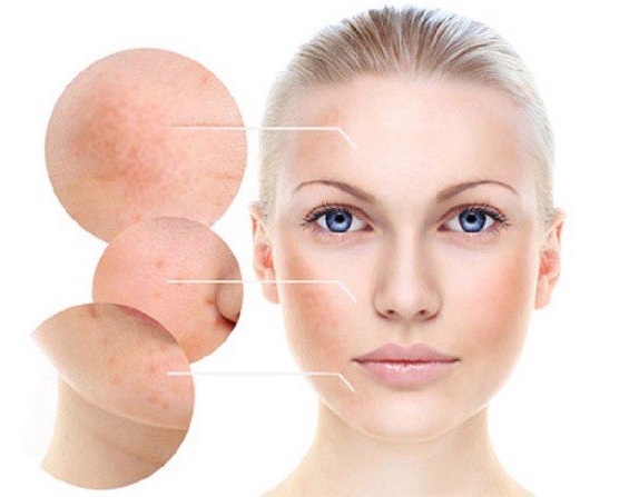 Gia công Kem trị nám tranexamic acid 10% 6 tình trạng nám da