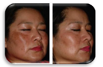 tác dụng giảm nám viatmin b3