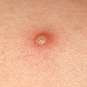 Nguyên nhân và phương pháp điều trị các loại mụn 35 mụn mủ