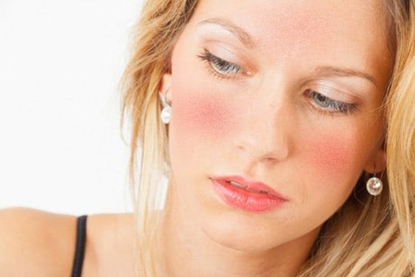 rosacea
