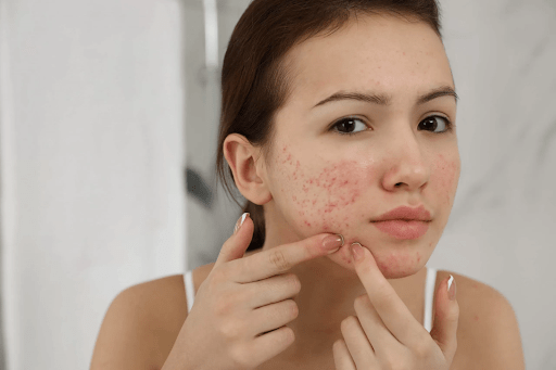 Gia công kem trị thâm là gì? Các loại kem trị thâm được gia công hiện nay 5 dieu tri tham mun dung cach min