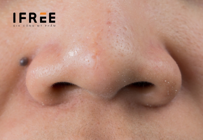 Mụn là gì: Các loại mụn, nguyên nhân và cách điều trị 15 Mụn là gì