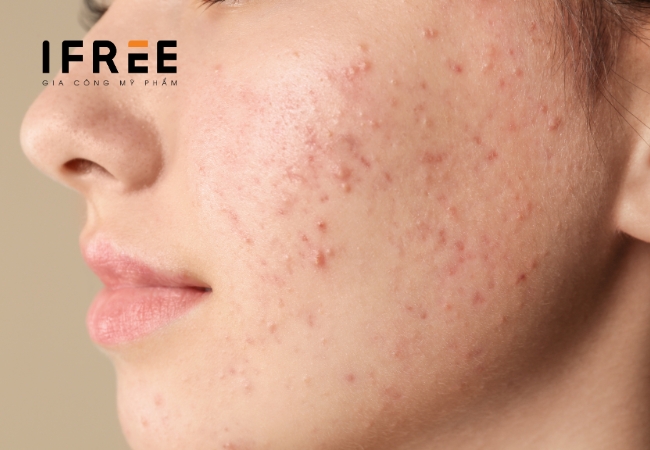 Mụn là gì: Các loại mụn, nguyên nhân và cách điều trị 16 Mụn là gì