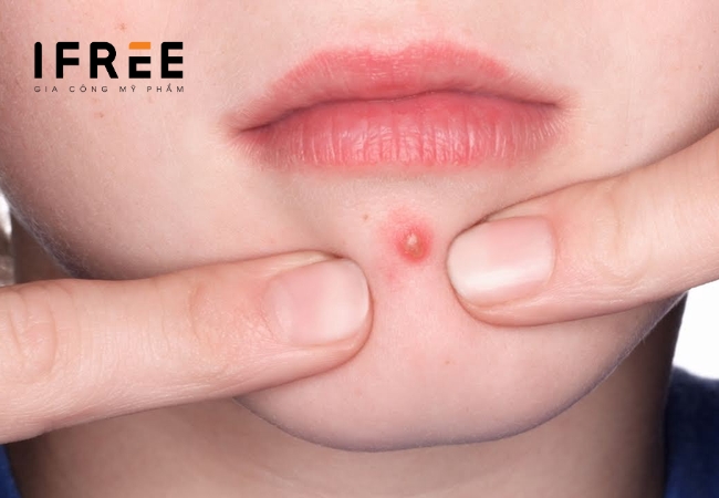 Mụn là gì: Các loại mụn, nguyên nhân và cách điều trị 18 Mụn là gì