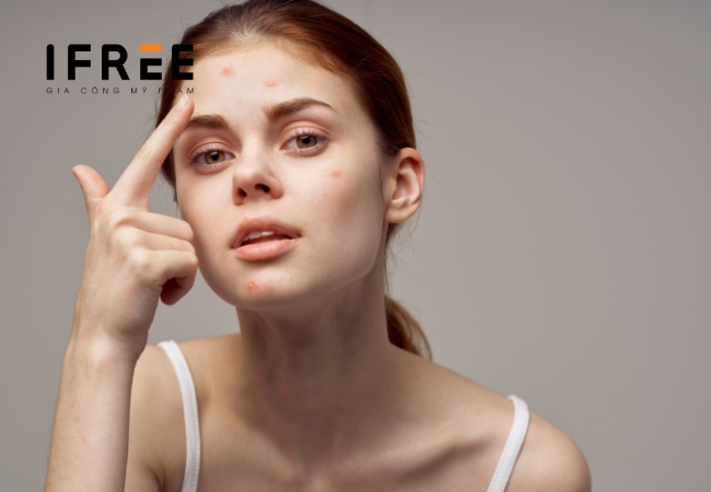 TOP 5+ công thức sữa rửa mặt cho da mụn được khuyên dùng 20 công thức sữa rửa mặt cho da mụn