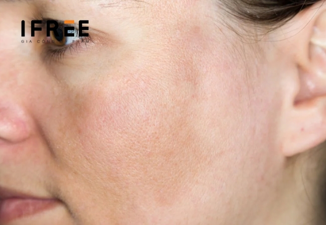 Tip cải thiện da không đều màu siêu đơn giản cùng iFREE 26 da không đều màu