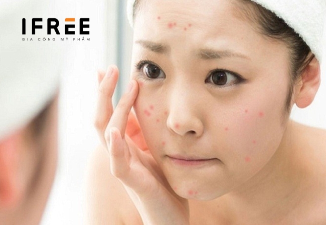 Da mụn dùng kem chống nắng - Nên hay không? 27 Da mụn dùng kem chống nắng