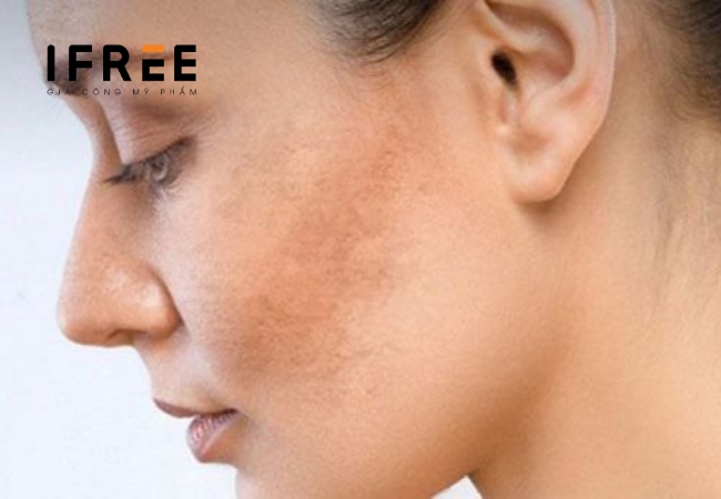 Da sạm đen do đâu? Làm thế nào để cải thiện? 11 Da sạm đen do đâu