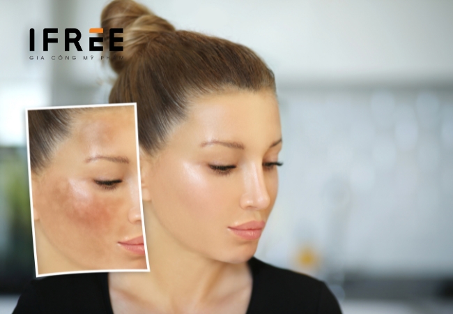 Da tăng sắc tố sau peel