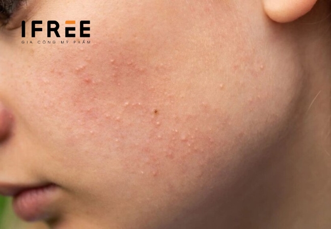 Làm sao để nhận biết da bạn đang bị mụn ẩn? 11 mụn ẩn