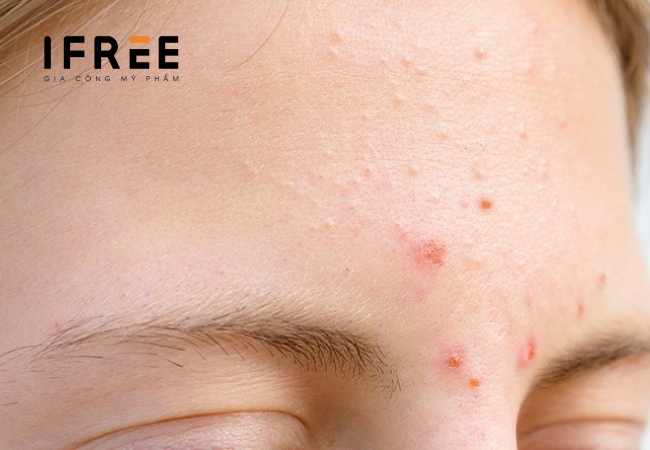 Làm sao để nhận biết da bạn đang bị mụn ẩn? 12 mụn ẩn