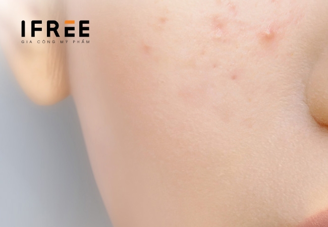 Làm sao để nhận biết da bạn đang bị mụn ẩn? 10 mụn ẩn