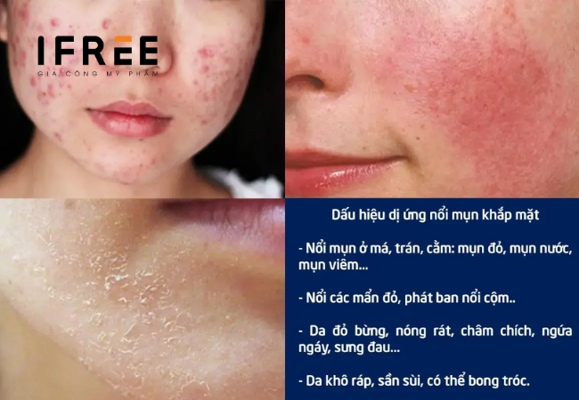 Mụn dị ứng là gì? Vì sao mụn dị ứng xuất hiện trên da? 8 Mụn dị ứng là gì