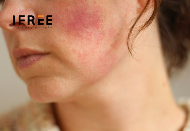 phục hồi da mỏng yếu