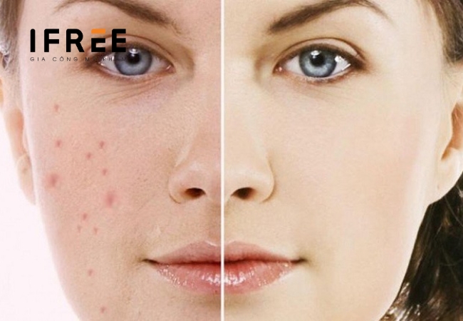 Bí quyết phục hồi da sau mụn cùng iFREE 55 Bí quyết phục hồi da sau mụn cùng iFREE