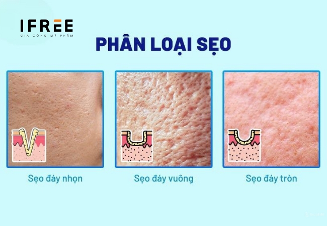 Sẹo rỗ - Ám ảnh trên da mà các chị em không muốn tẹo nào 13 Sẹo rỗ