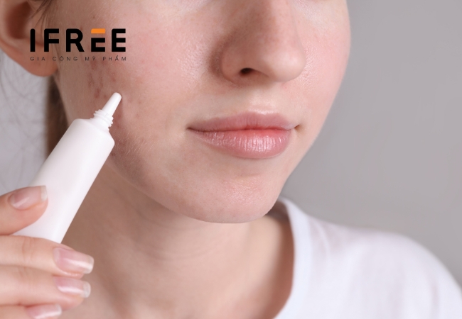 Sẹo rỗ - Ám ảnh trên da mà các chị em không muốn tẹo nào 24 Sẹo rỗ