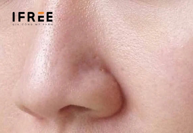 Sợi bã nhờn là gì? Ảnh hưởng trên da thế nào? 41 Sợi bã nhờn là gì