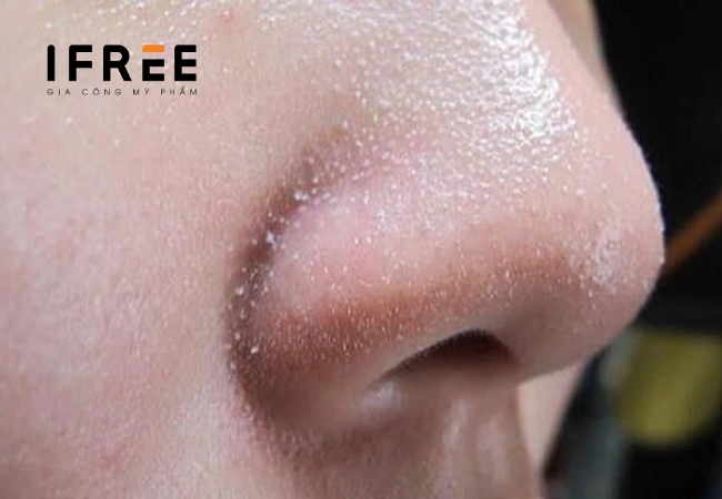 Sợi bã nhờn là gì? Ảnh hưởng trên da thế nào? 40 Sợi bã nhờn là gì