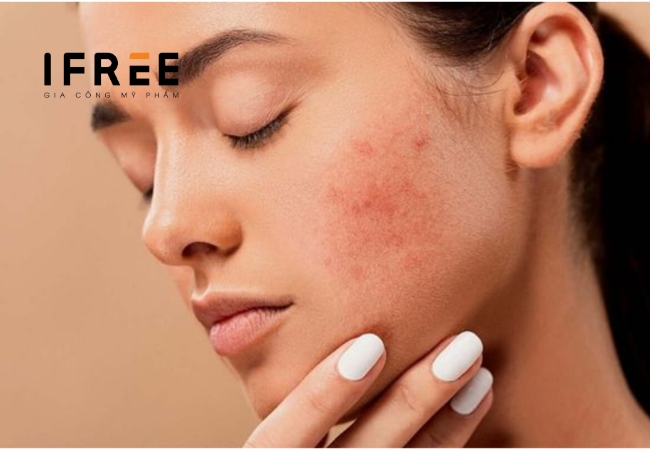 Cồn trong mỹ phẩm - Có lợi hay có hại cho da? 47 Cồn trong mỹ phẩm - Có lợi hay có hại cho da?