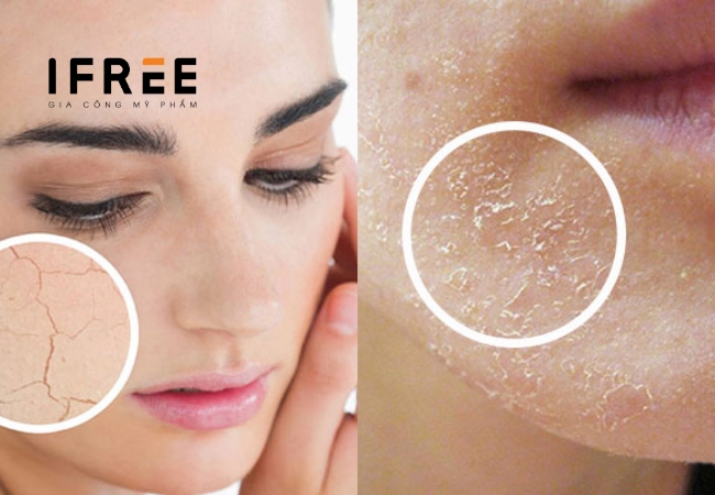 Làm gì để cải thiện tình trạng da bị bong tróc vào mùa đông? 31 Làm gì để cải thiện tình trạng da bị bong tróc vào mùa đông?