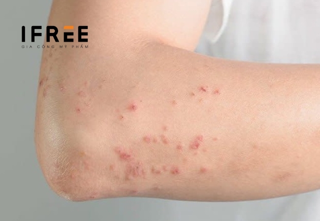 Kem kích trắng là gì? Có an toàn khi dùng không?