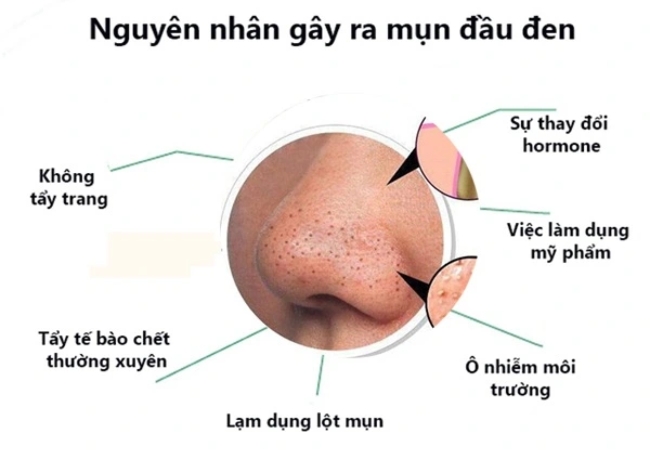 Hướng dẫn cách trị mụn đầu đen hiệu quả 45 Hướng dẫn cách trị mụn đầu đen hiệu quả