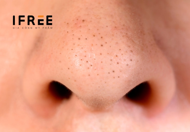 Hướng dẫn cách trị mụn đầu đen hiệu quả 44 Hướng dẫn cách trị mụn đầu đen hiệu quả