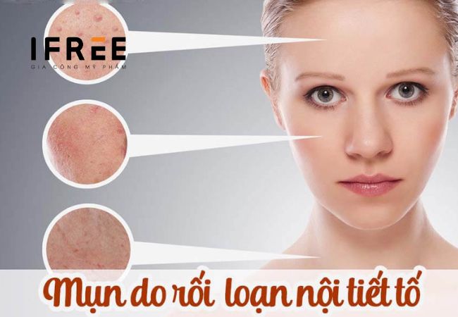 Chăm da bị mụn nội tiết thế nào?