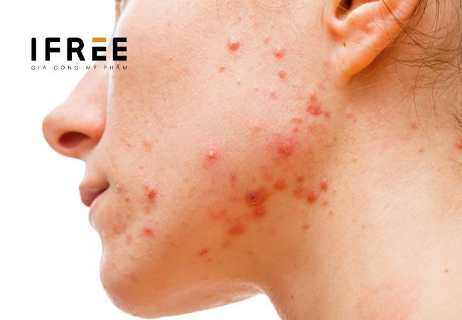 Chăm da bị mụn nội tiết thế nào?