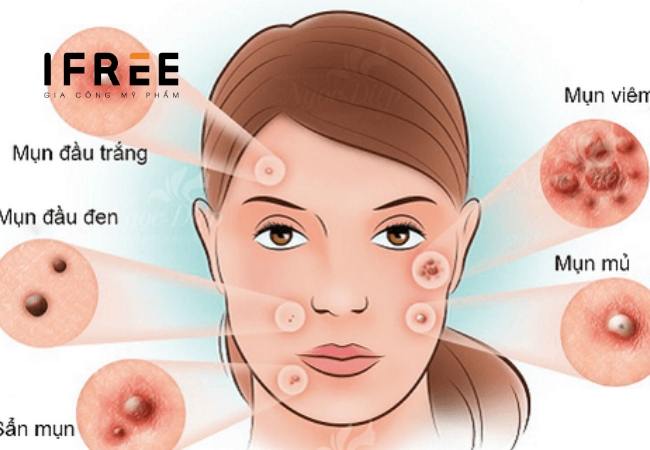 Mụn tuổi dậy thì - Chăm da thế nào?