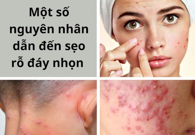 Phân biệt sẹo đáy nhọn và lỗ chân lông to