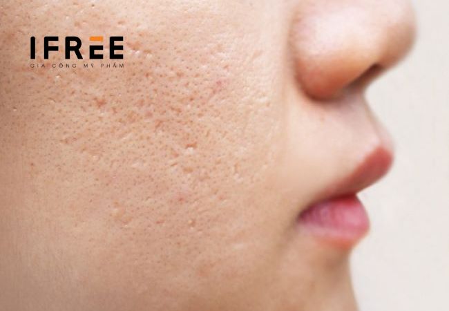 Phân biệt sẹo đáy nhọn và lỗ chân lông to