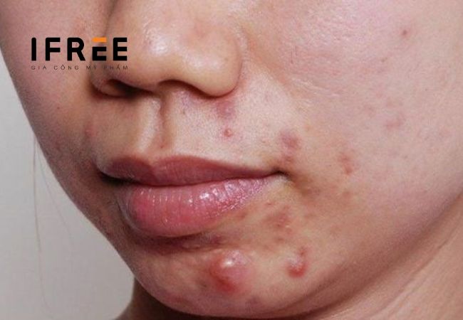 Mụn trứng cá là gì? Điều trị thế nào?