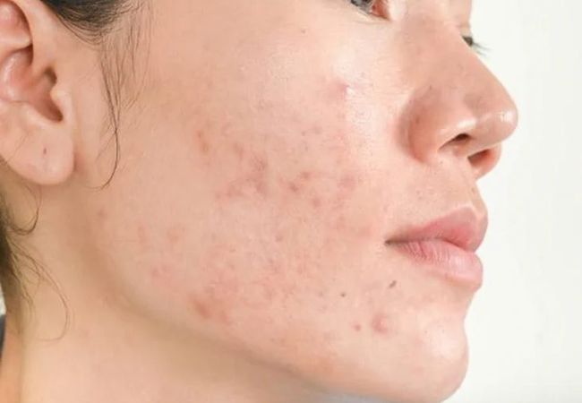 Mụn trứng cá là gì? Điều trị thế nào?