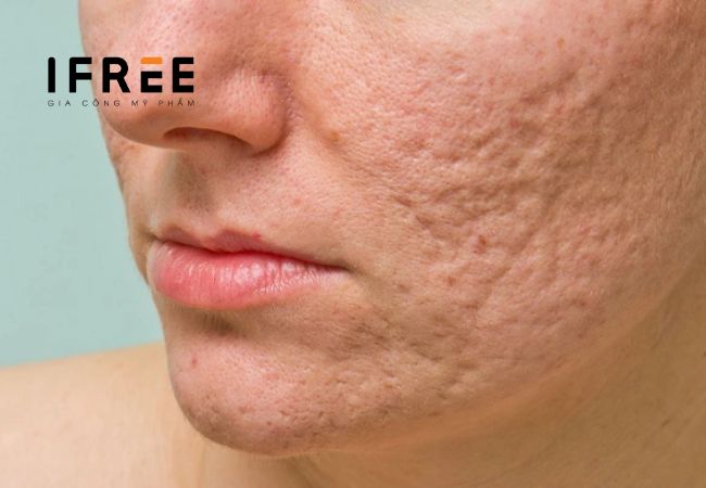 Mụn trứng cá là gì? Điều trị thế nào?