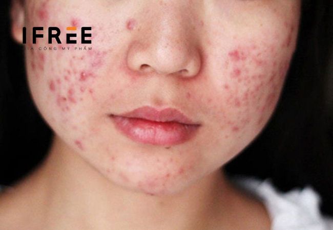 Mụn trứng cá là gì? Điều trị thế nào?