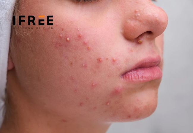 Mụn trứng cá là gì? Điều trị thế nào?