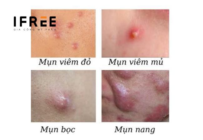 Mụn viêm là gì? Chăm sóc da có mụn viêm thế nào?