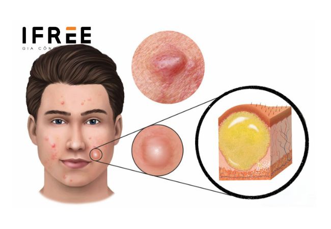 Mụn viêm là gì? Chăm sóc da có mụn viêm thế nào?