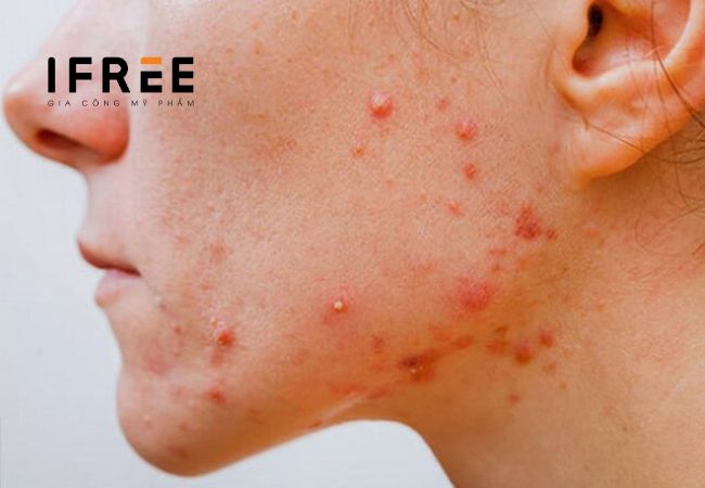 Mụn viêm là gì? Chăm sóc da có mụn viêm thế nào?