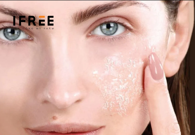 iFREE giải đáp: Peel da trị nám có hiệu quả không?