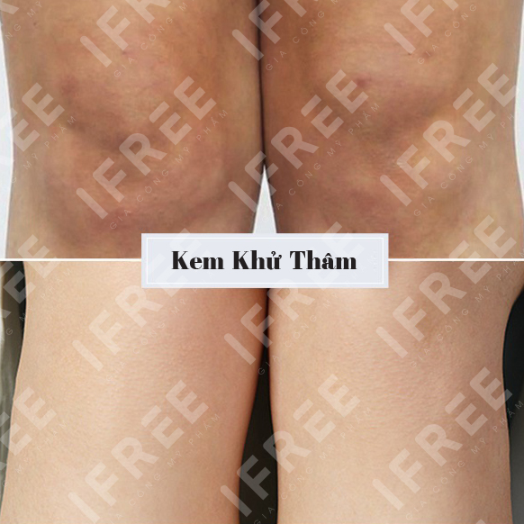 Gia công kem khử thâm body - Bí quyết cho làn da sáng mịn toàn diện